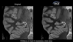 Canon Medical AI 算法获 FDA 批准，将应用于 MR 设备