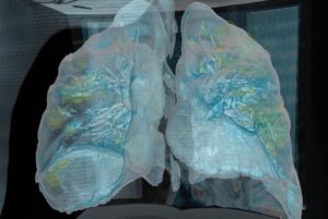 3D 成像看武汉肺炎病毒可怕之处：无症状感染数天，肺部就多处受损